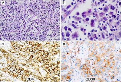 Follicular Dendritic Cell Sarcoma With Co-Expression of CD4 and <mark class="highlighted">CD30</mark> Mimics Anaplastic Large Cell Lymphoma
